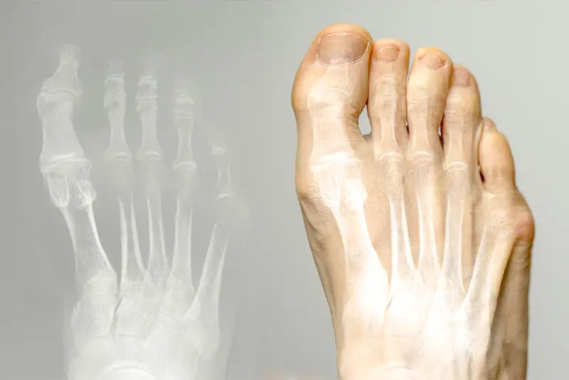 North Bristol Private Hospital - Big Toe Arthritis