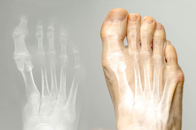 North Bristol Private Hospital - Big Toe Arthritis