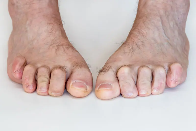 North Bristol Private Hospital - Lesser Toe Deformities